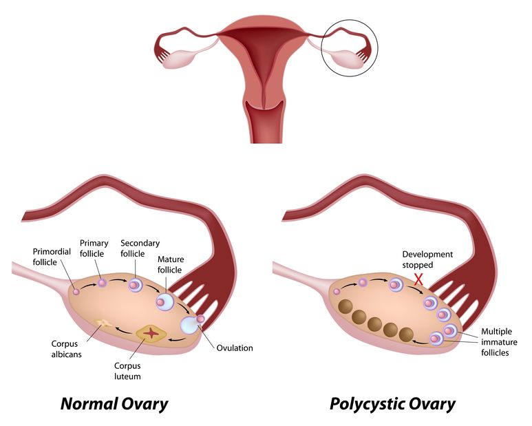 Das Polyzystische Ovarialsyndrom führt nicht selten zu unerfülltem Kinderwunsch. www.anyworkingmom.com/pcos