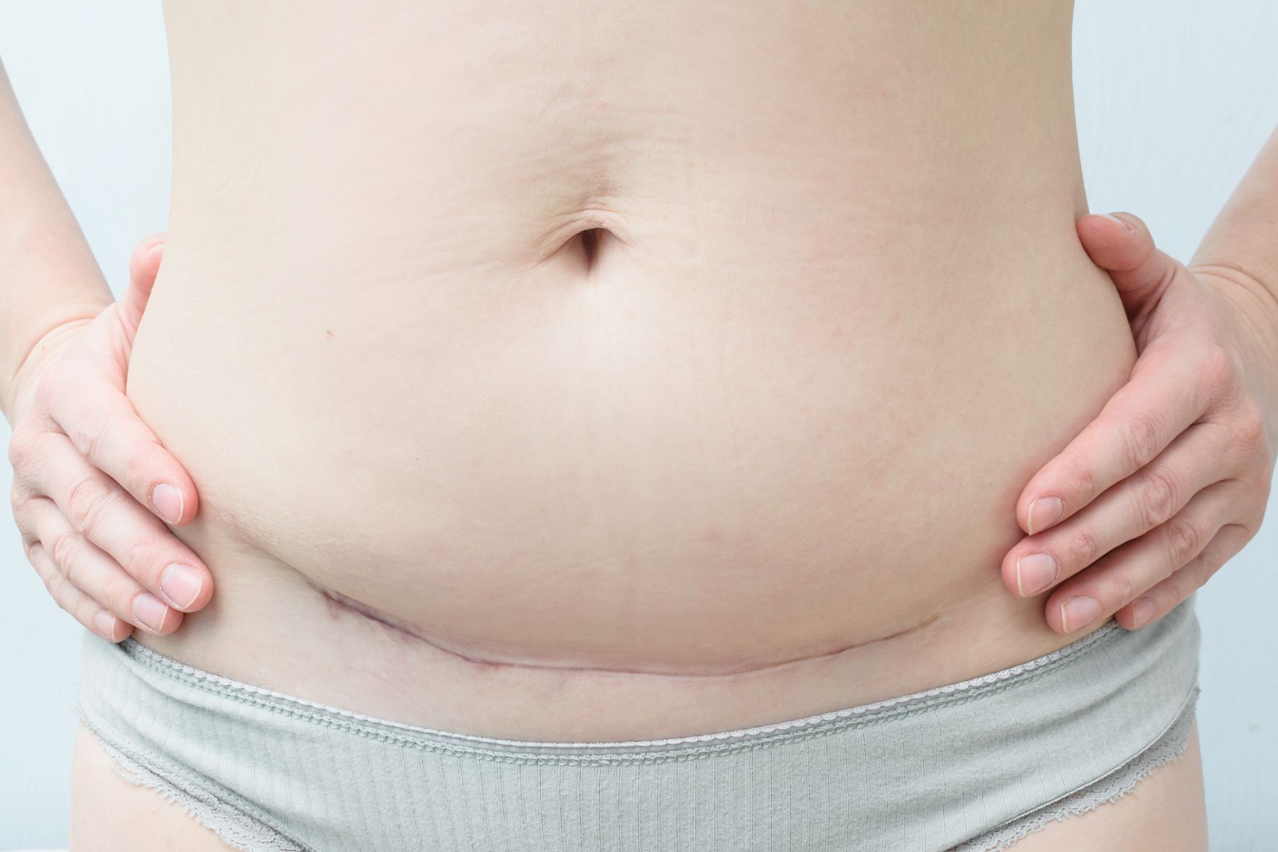 Frauen, die mit Kaiserschnitt gebären, müssen sich oft dafür rechtfertigen. Dabei ist eine operative Geburt keinesfalls "the easy way out". Ein Erfahrungsbericht.