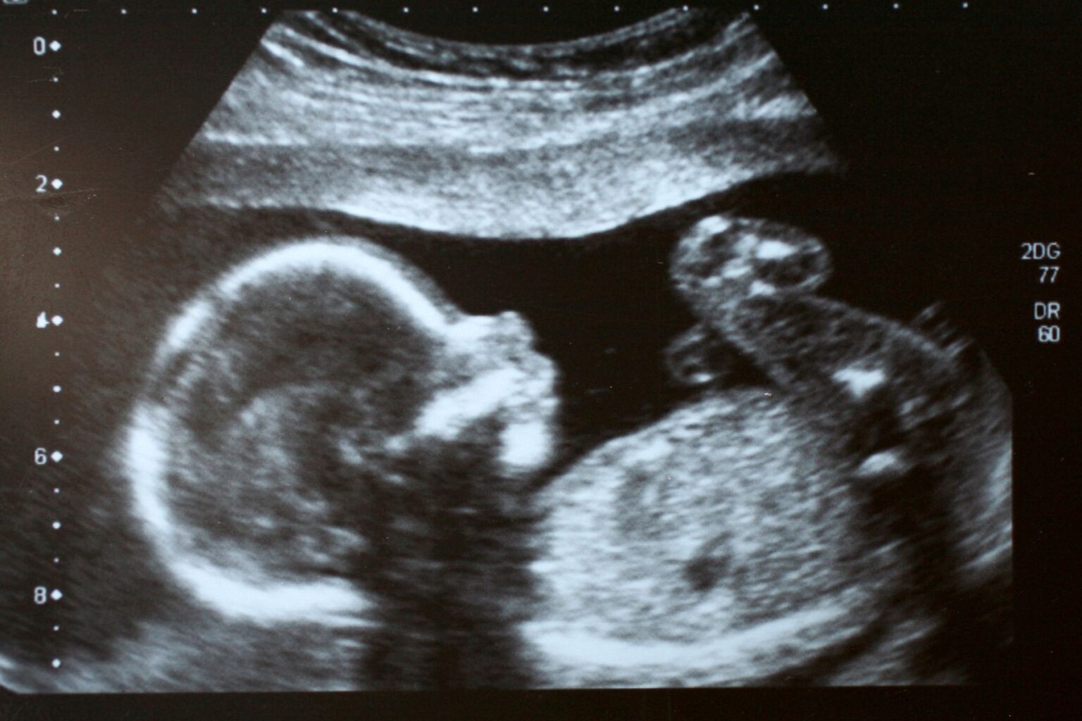 Wann Habt Ihr Das Geschlecht Eures Babys Erfahren Schwangerschaft: Ab wann lässt sich das Geschlecht des Babys bestimmen