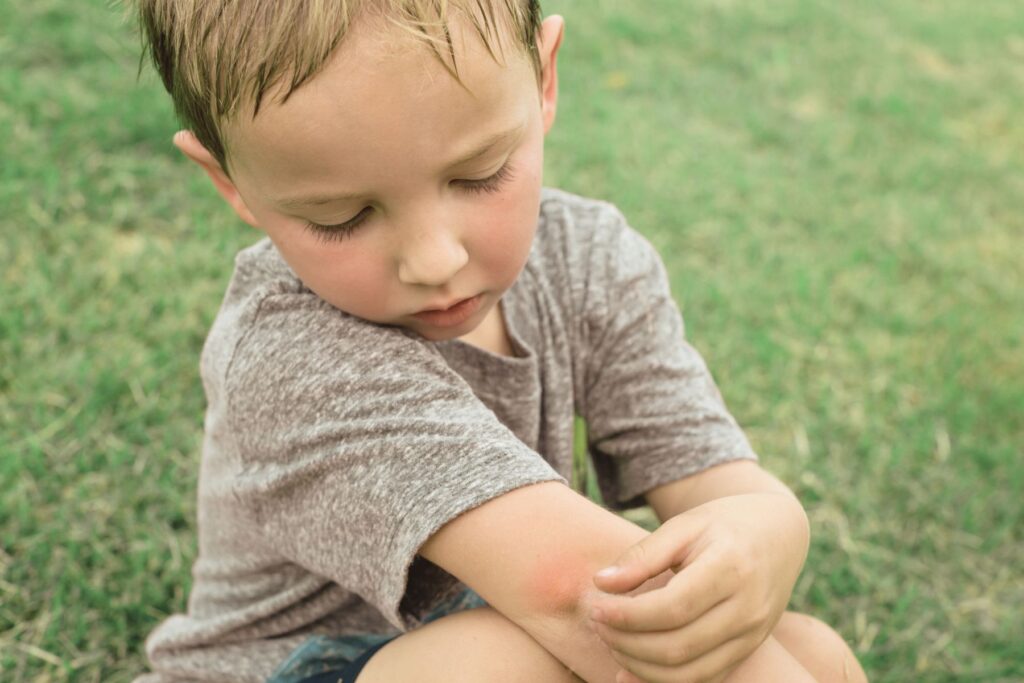Kind hat einen Insektenstich